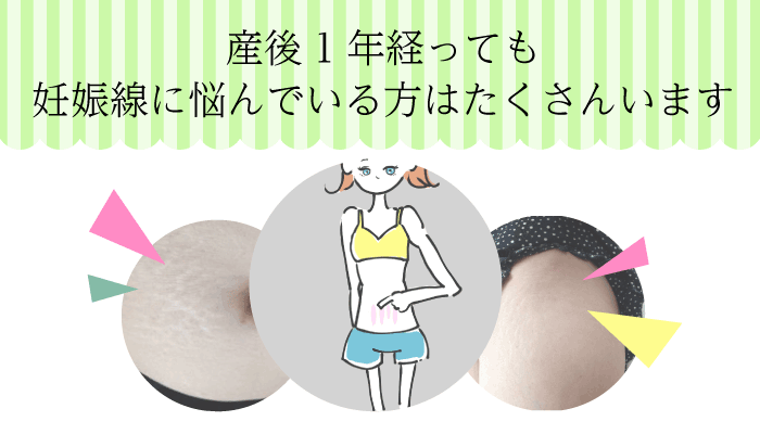 娠線をクリームで消すことはできるの?
